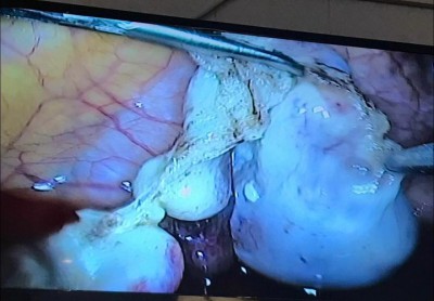 CA PHẪU THUẬT TỪ SÁNG SỚM - CẢM ƠN BỆNH NHÂN ĐÃ TIN TƯỞNG