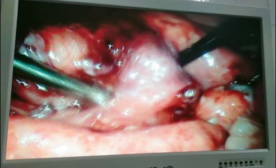 CẦN CẢNH GIÁC CÁC CƠN ĐAU VÙNG BỤNG KÈM THEO SỐT CAO TÁI PHÁT NHIỀU LẦN