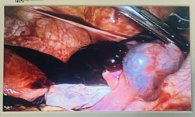 TRUNG TÂM Y TẾ CAN LỘC XỬ LÝ KỊP THỜI CA CHỬA NGOÀI DẠ CON VỠ CHẢY MÁU Ổ BỤNG