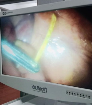 PHẪU THUẬT CẤP CỨU BỆNH NHÂN BỊ THỦNG RUỘT DO NUỐT TĂM TRE